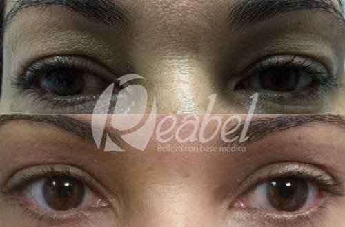 BLEFAROPLASTIA SIN CIRUGIA